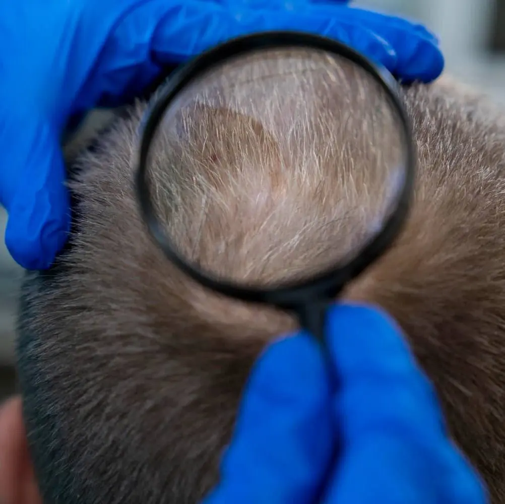 Man with hair condition being examined by dermatologist